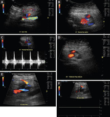 Current Treatment Options for Femoral Pseudoaneurysms - Cardiac ...