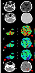 ior circulation stroke