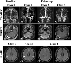 Cerebral venous sinus thrombosis