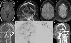 Cerebral Venous Thrombosis