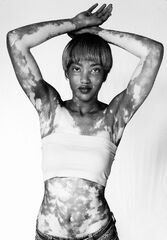 From Vitiligo to Birthmarks: The Beauty of Human Skin - Feature Shoot