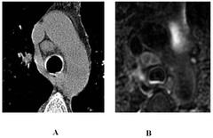 Detection of Pulmonary tuberculosis: comparing MR imaging with ...