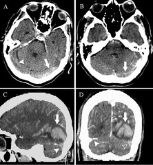 Simultaneous Occurrence of Cerebral Venous Sinus Thrombosis and ...