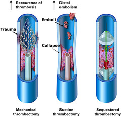 Multimodal thrombectomy device for treatment of acute deep venous ...