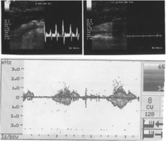 A clinical case series of COVID-19-associated acute limb ischemia ...