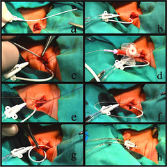 Modified Seldinger technique for internal jugular open central ...