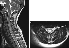 Radiological approach to non-compressive myelopathies | Egyptian ...