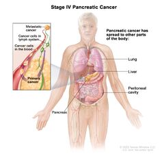 Pancreatic Cancer Treatment - NCI