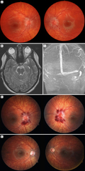 Hemorrhagic papilledema following lumbar puncture | Digital ...