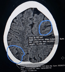 Cureus | Cortical Blindness and Thrombotic Microangiopathy ...