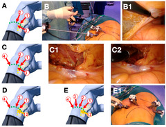 Cancers |-Text | The Transabdominal Lumbar Approach ...