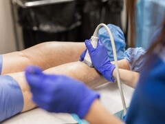 How Advanced Ultrasound Technology Modernizes Treatment for Venous ...