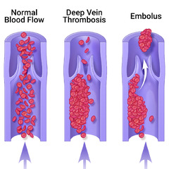 Deep Vein Thrombosis (DVT) - Memphis Vascular Center