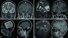 Diagnostic Accuracy of High-Resolution 3D T2-SPACE in Detecting ...