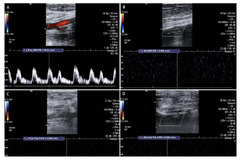 Acute Limb Ischemia: Clot and Catheter | VDM