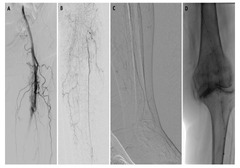 Acute Limb Ischemia: Clot and Catheter | VDM