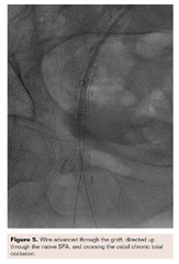 Acoustic Pulse Thrombolysis for Acute Limb Ischemia | VDM