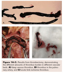 Acoustic Pulse Thrombolysis for Acute Limb Ischemia | VDM