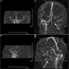 Cerebral venous sinus thrombosis