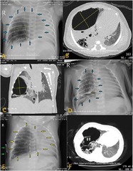 Frontiers | Percutaneous transthoracic catheter drainage prior to ...