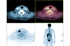 Thyroid Cancer: Pharmacologic Management - Cancer Therapy Advisor