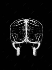 MRV Brain or magnetic resonance venography of The Brain for abnormalities in venous drainage of the