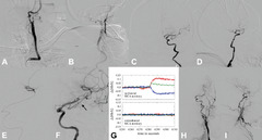 Image-Guided, Interventional Therapy of Acute Stroke (Chapter 20 ...