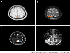 Rare cause of cerebral venous sinus thrombosis: Spontaneous ...