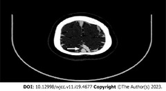 Rare cause of cerebral venous sinus thrombosis: Spontaneous ...