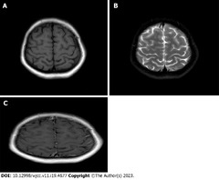 Rare cause of cerebral venous sinus thrombosis: Spontaneous ...