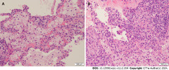 Primary biliary cholangitis presenting with granulomatous lung ...